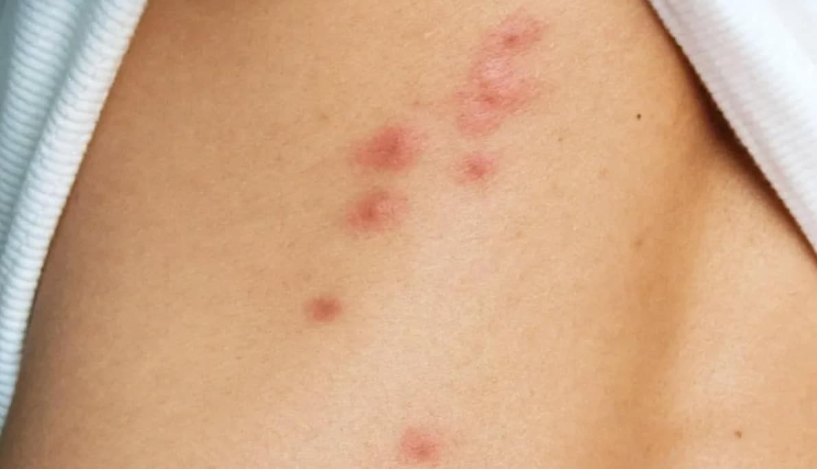 Signs of Bed Bug Infestation